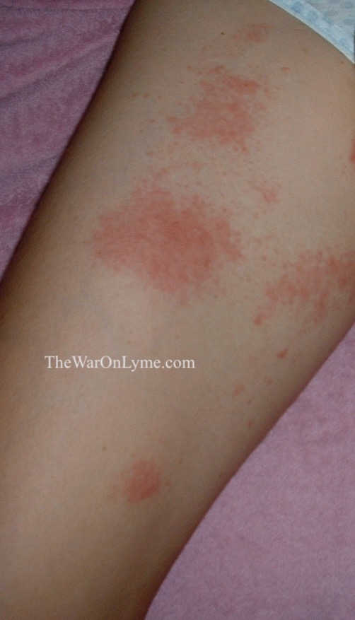Rashes and Lyme Disease • The War on Lyme