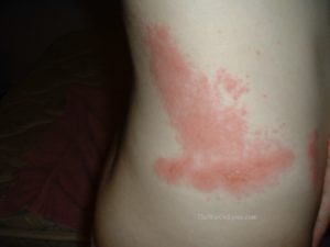lyme disease rash